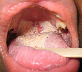 Candida Albicans Symptoms